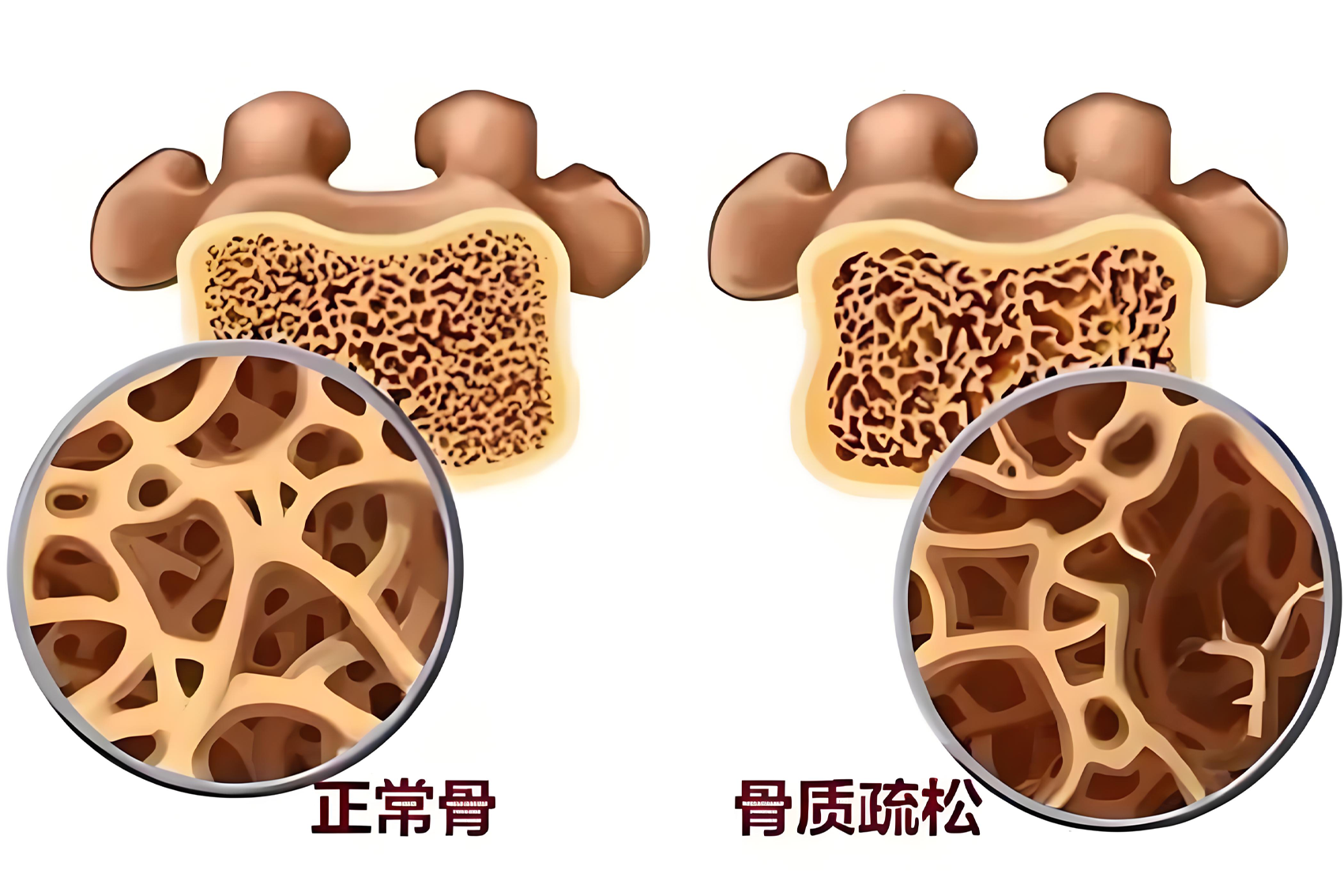 守护骨健康！骨质疏松诊断利器点亮医院临床实践